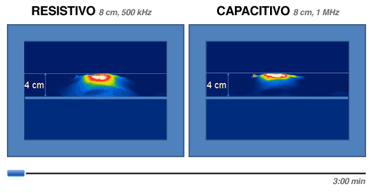 Tratamiento de 3 minutos apicando manípulos resistivo y capacitivo